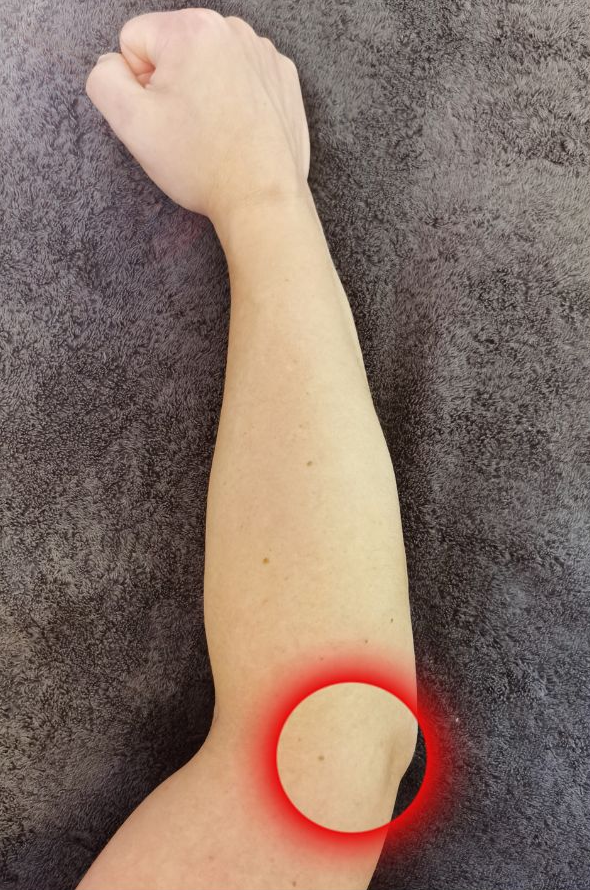 Tenniskyynärpää kuvituskuva